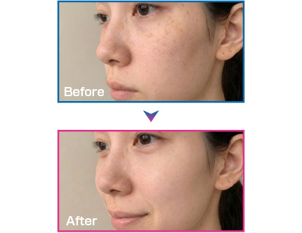 脱毛と美肌のW効果